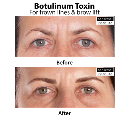 static wrinkles under eyes