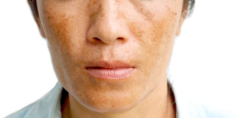 melasma doctors near me
