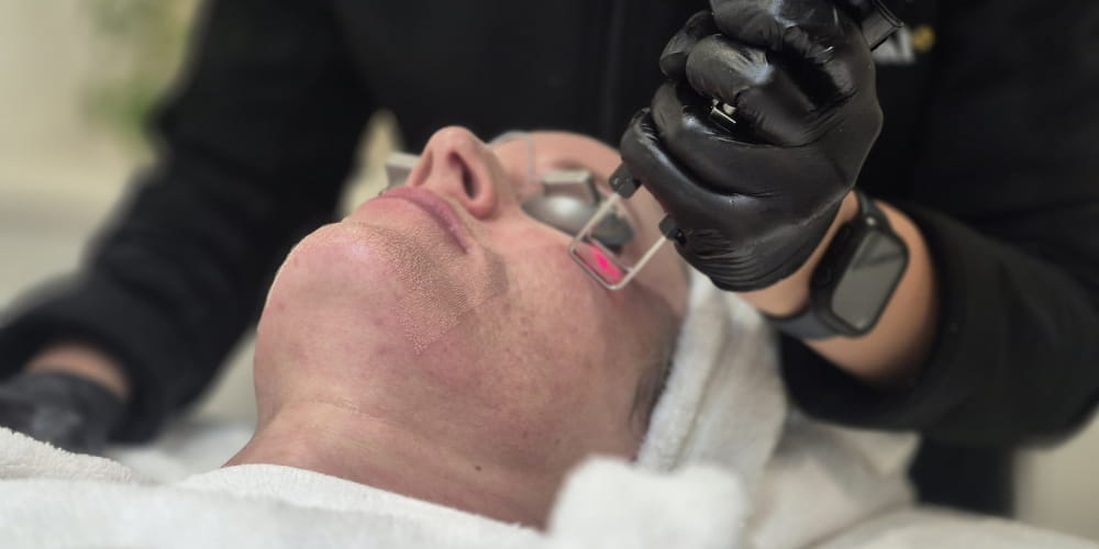 Thumbnail for How Co2 Laser Transforms Your Skin