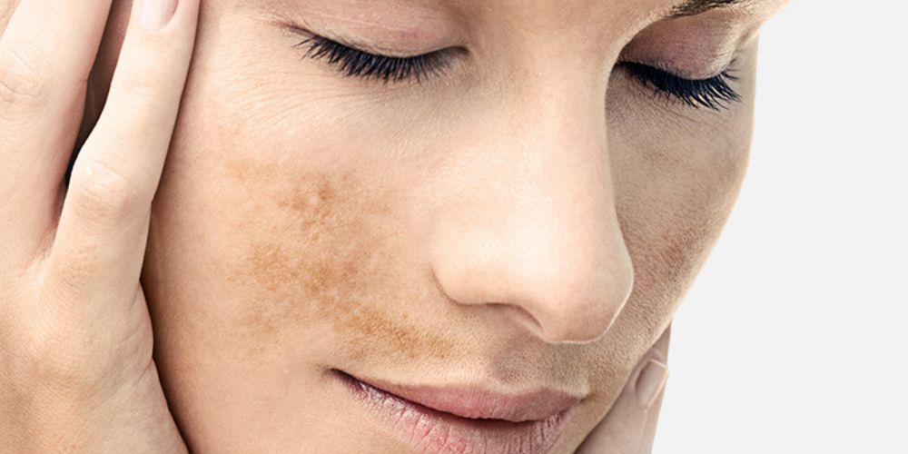 Thumbnail for Melasma Explained