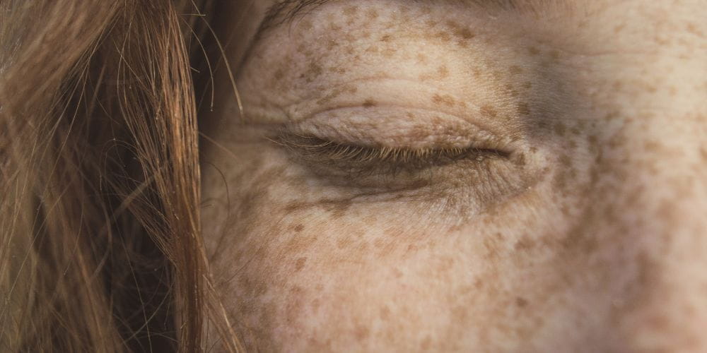 Thumbnail for Three Types of Pigmentation - Video