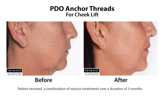 pdo threads before and after pdo threads before and after
