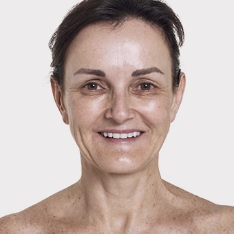 Mooimaak | Behind the Scenes | Skin Renewal | Kyknet