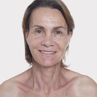 Mooimaak | Behind the Scenes | Skin Renewal | Kyknet